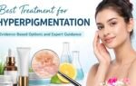 Best Treatment for Hyperpigmentation: Evidence-Based Options and Expert Guidance